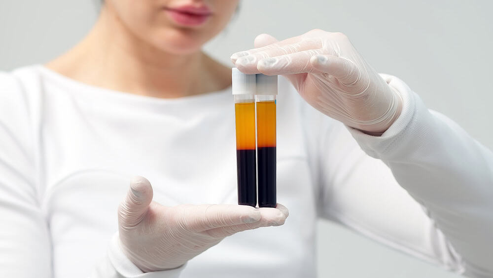 เจ้าหน้าที่เตรียม PRP สำหรับฉีดฟื้นฟูรังไข่เพื่อเพิ่มโอกาสตั้งครรภ์ในผู้ที่มีภาวะมีบุตรยาก